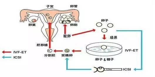 兰州试管婴儿